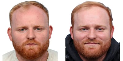 FUE Hair Transplant Before & After Gallery - Patient 160744 - Image 1