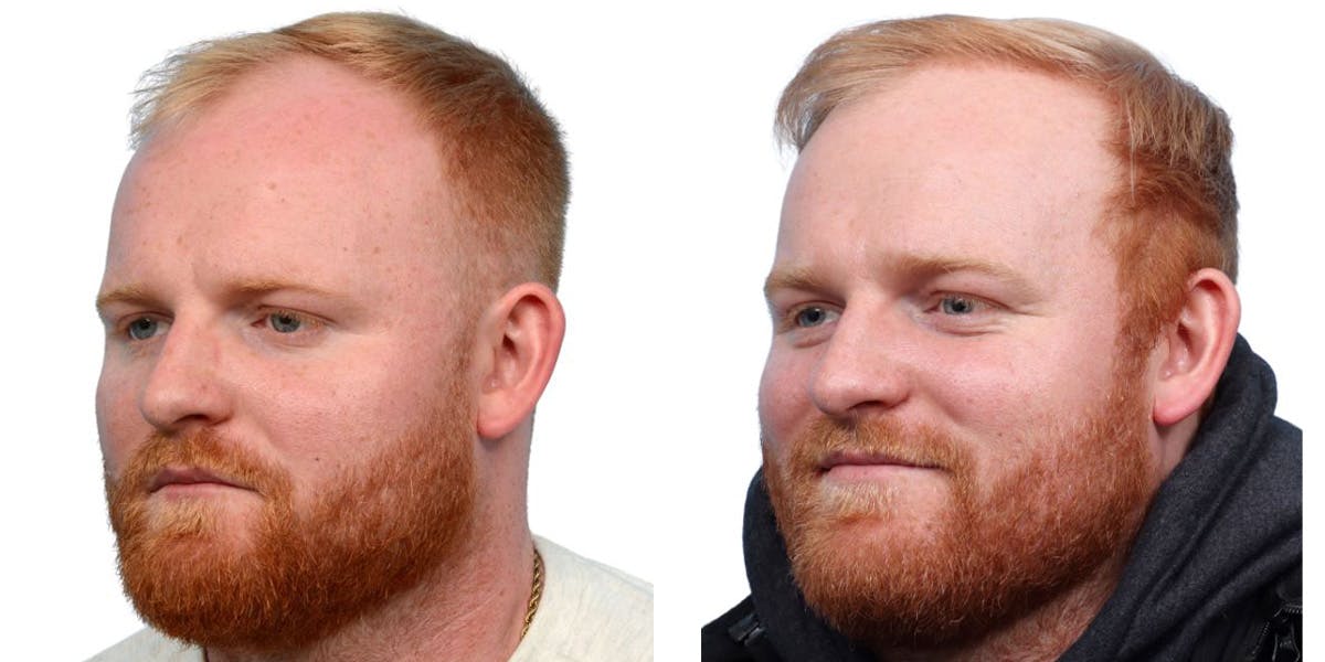 FUE Hair Transplant Before & After Gallery - Patient 160744 - Image 2
