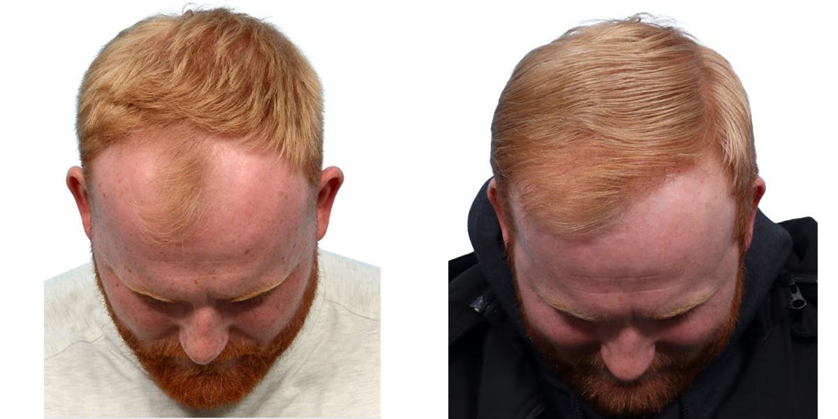 FUE Hair Transplant Before & After Gallery - Patient 160744 - Image 3