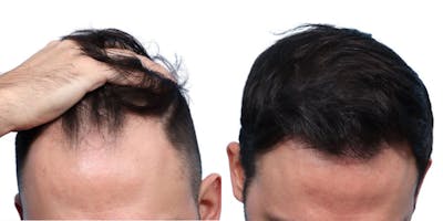 FUE Hair Transplant Before & After Gallery - Patient 242783 - Image 1