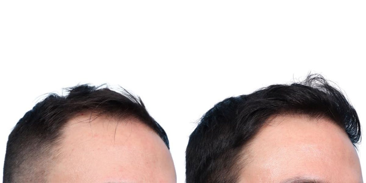 FUE Hair Transplant Before & After Gallery - Patient 242783 - Image 3