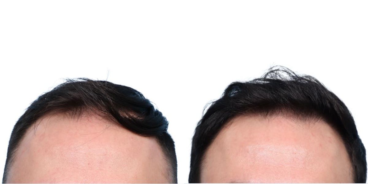 FUE Hair Transplant Before & After Gallery - Patient 242783 - Image 2