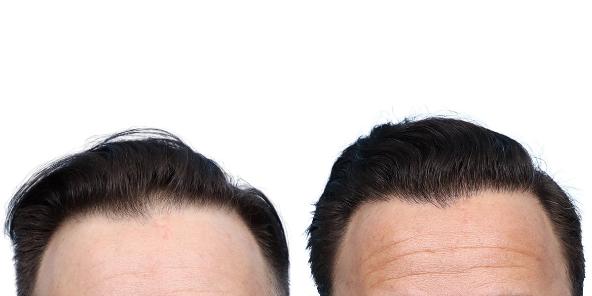 FUE Hair Transplant Before & After Gallery - Patient 350311 - Image 1