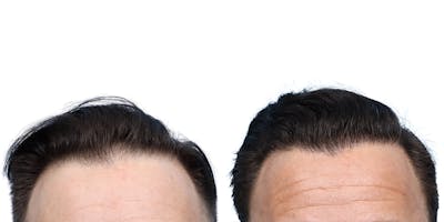 FUE Hair Transplant Before & After Gallery - Patient 350311 - Image 1