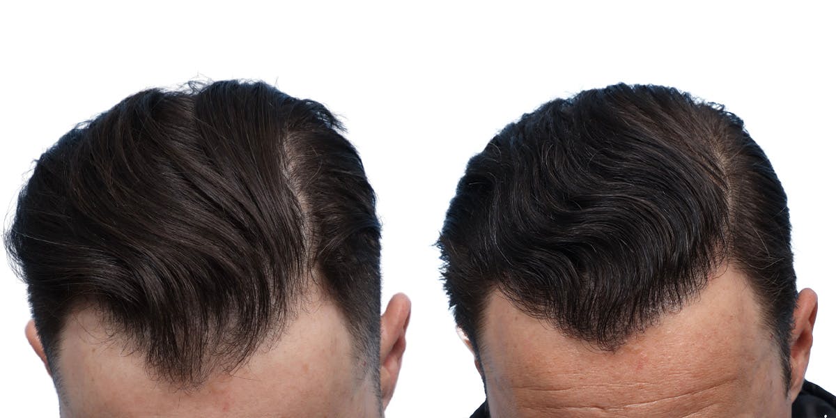 FUE Hair Transplant Before & After Gallery - Patient 350311 - Image 5