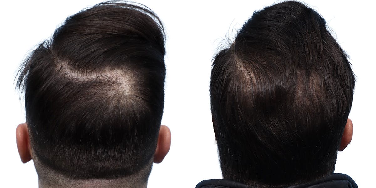FUE Hair Transplant Before & After Gallery - Patient 350311 - Image 4