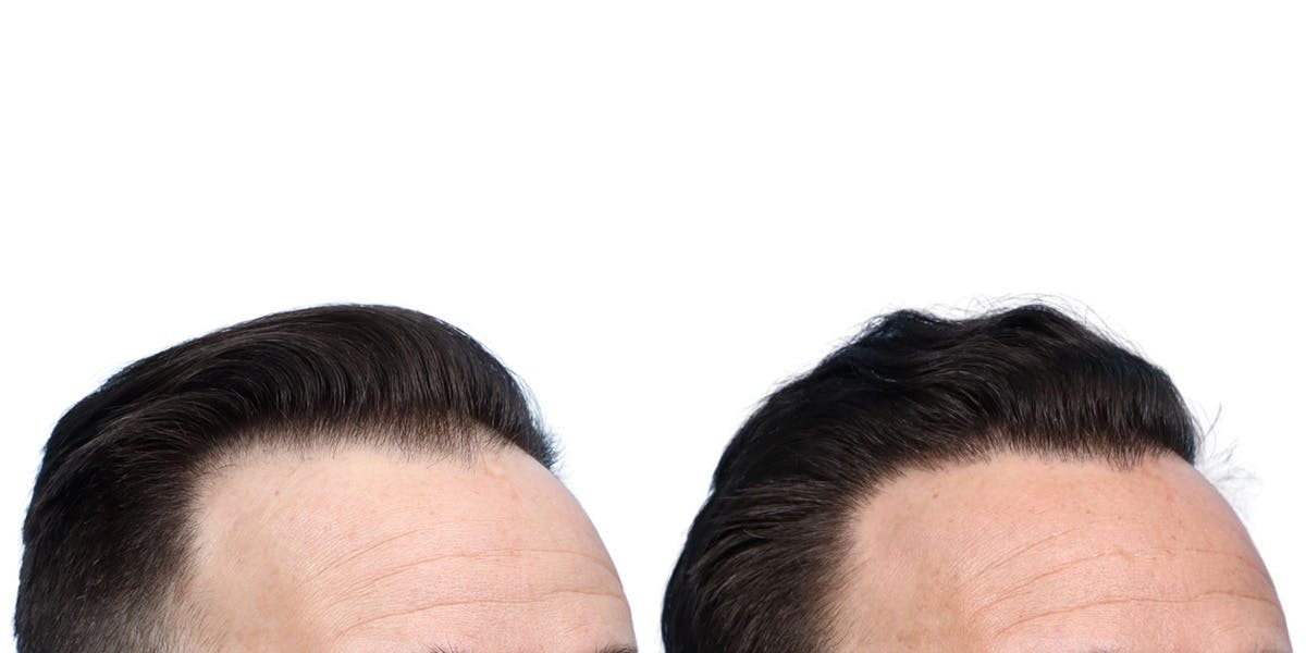 FUE Hair Transplant Before & After Gallery - Patient 350311 - Image 2