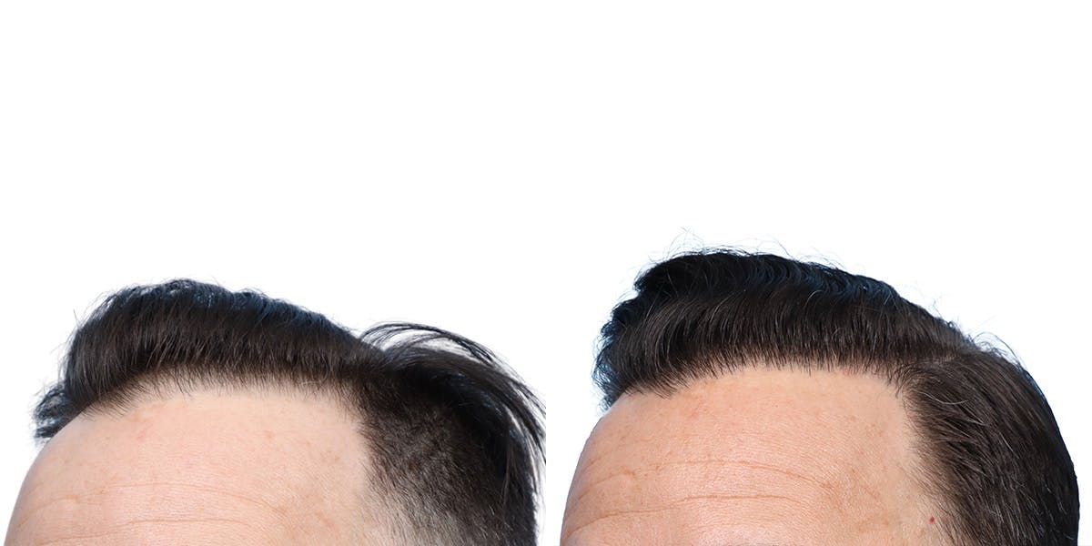 FUE Hair Transplant Before & After Gallery - Patient 350311 - Image 3