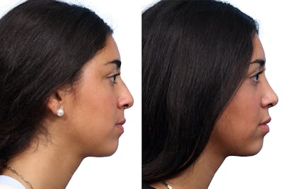 Rhinoplasty Before & After Gallery - Patient 167399 - Image 1