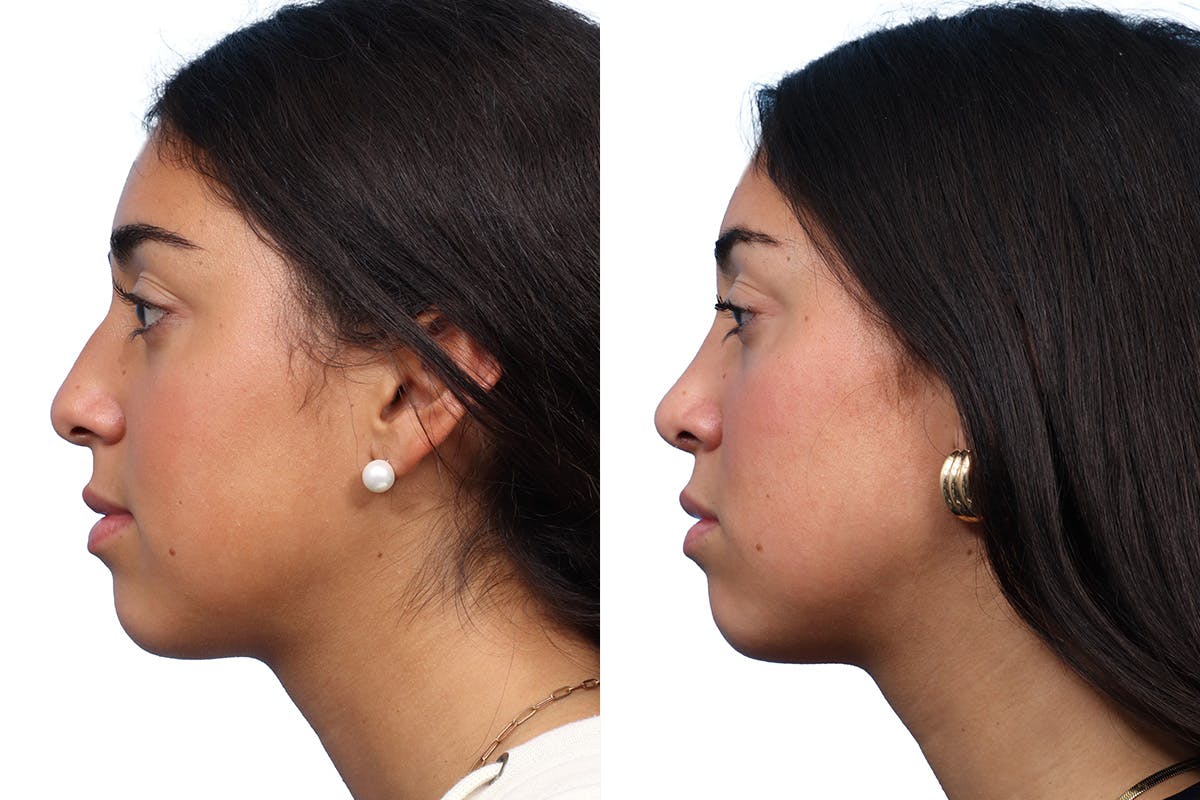Rhinoplasty Before & After Gallery - Patient 167399 - Image 2