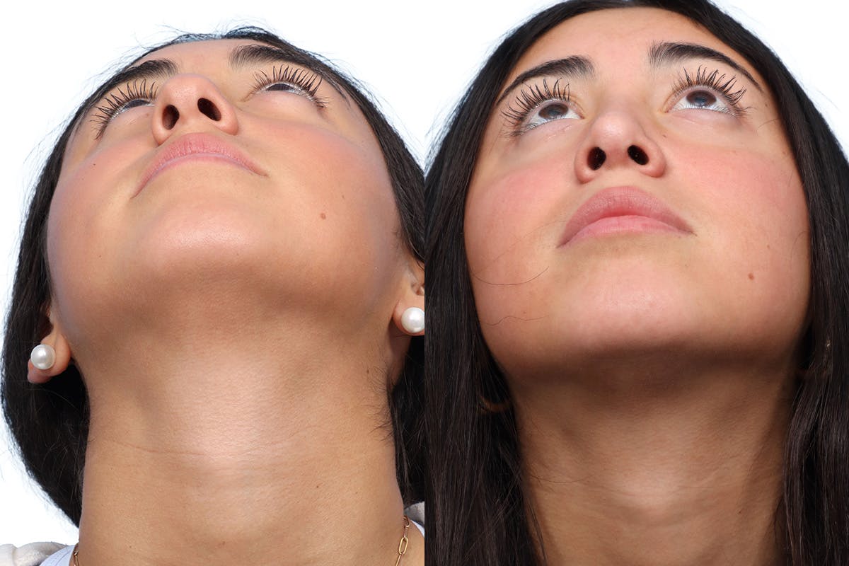 Rhinoplasty Before & After Gallery - Patient 167399 - Image 4
