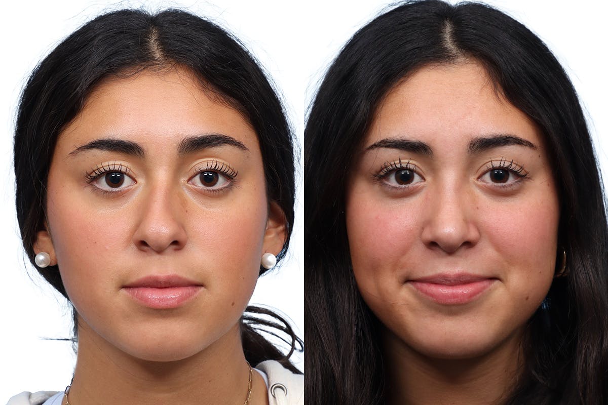 Rhinoplasty Before & After Gallery - Patient 167399 - Image 3