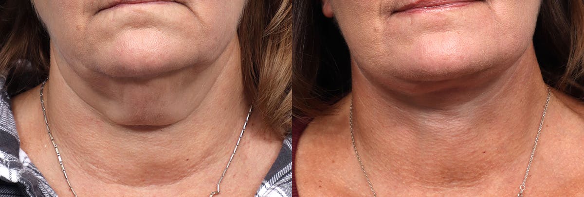 Deep Plane Facelift Before & After Gallery - Patient 375548 - Image 1