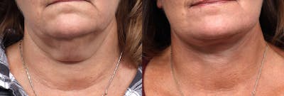 Deep Plane Facelift Before & After Gallery - Patient 375548 - Image 1