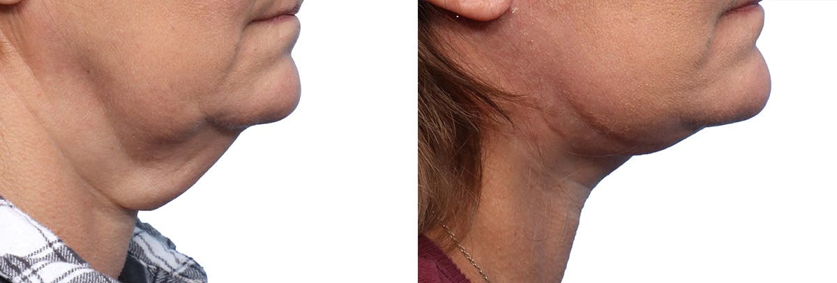 Deep Plane Facelift Before & After Gallery - Patient 375548 - Image 2