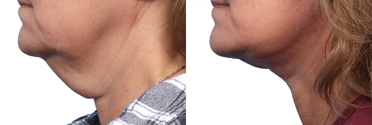 Deep Plane Facelift Before & After Gallery - Patient 375548 - Image 3