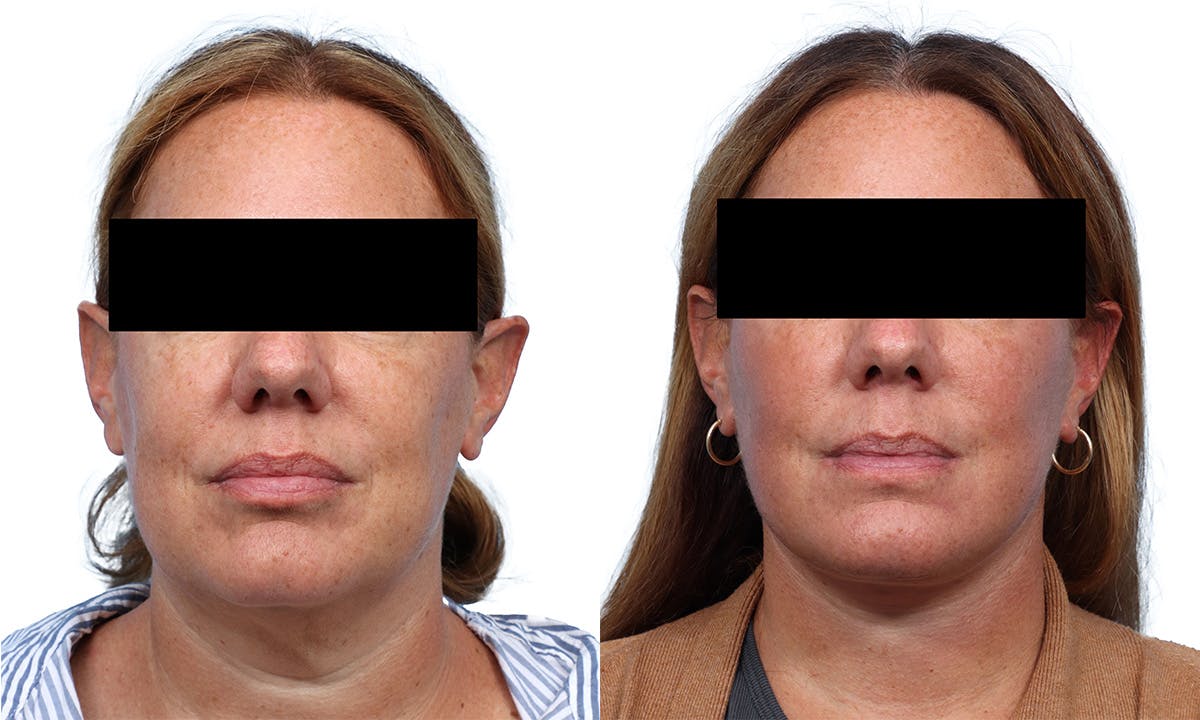 Deep Plane Facelift Before & After Gallery - Patient 308099 - Image 1