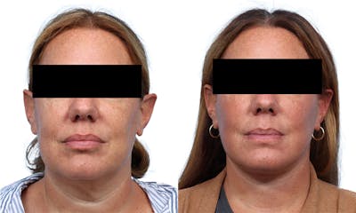 Deep Plane Facelift Before & After Gallery - Patient 308099 - Image 1
