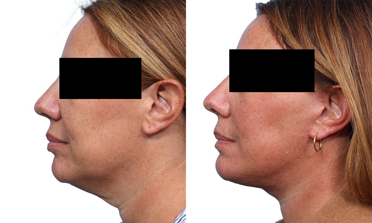 Deep Plane Facelift Before & After Gallery - Patient 308099 - Image 3