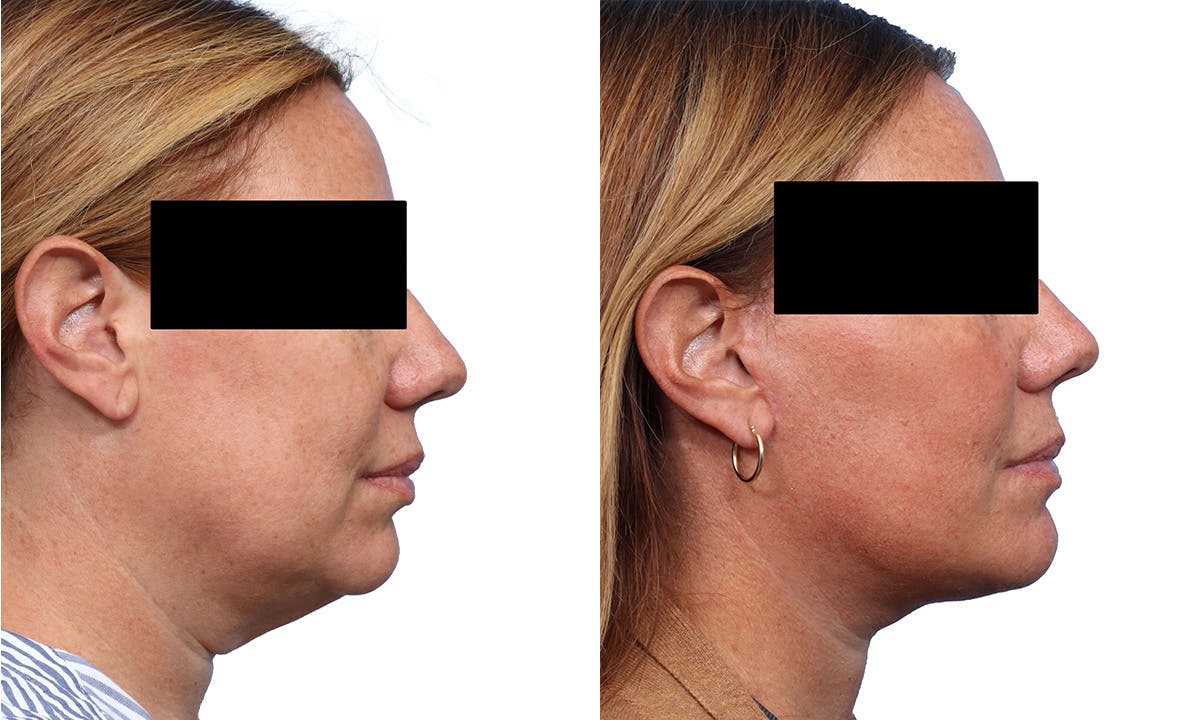 Deep Plane Facelift Before & After Gallery - Patient 308099 - Image 2