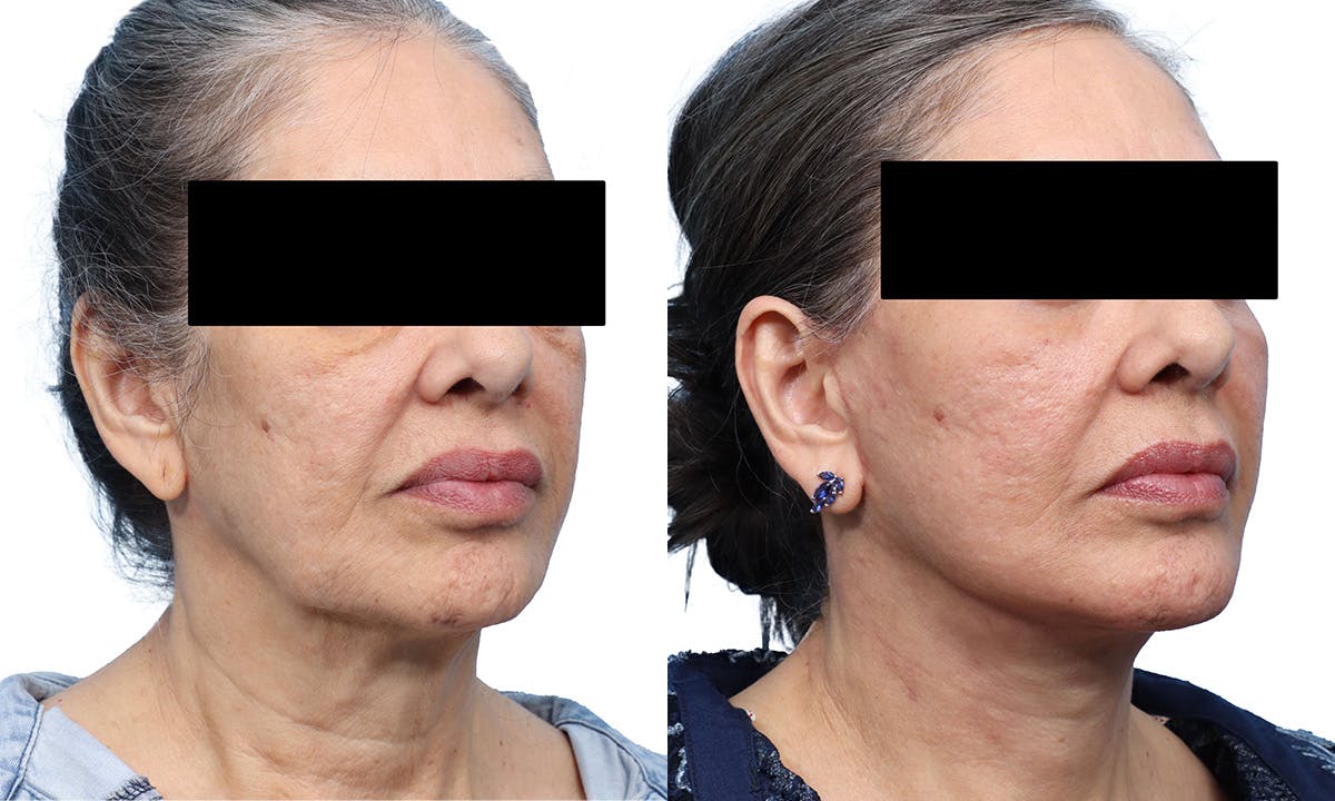 Deep Plane Facelift Before & After Gallery - Patient 120828 - Image 1