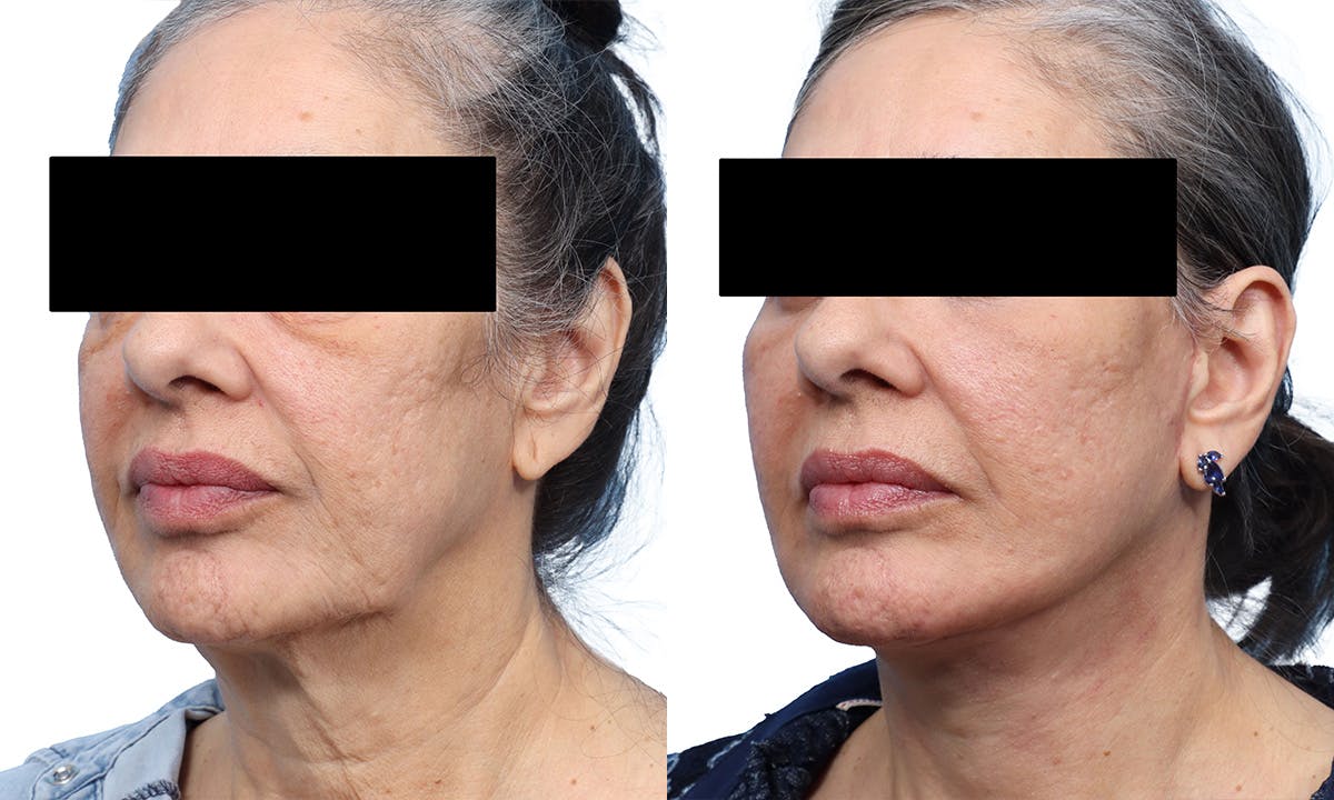 Deep Plane Facelift Before & After Gallery - Patient 120828 - Image 2