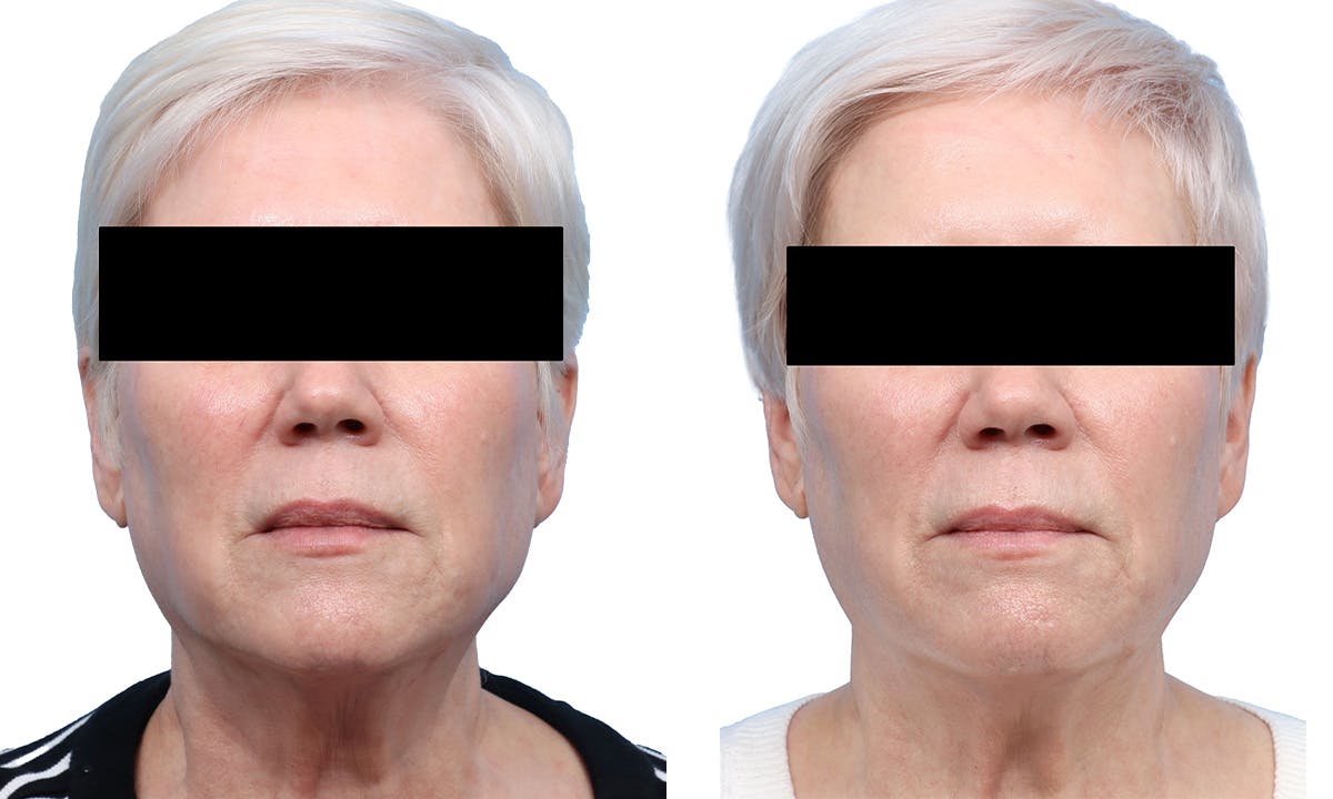 Lutronic Ultra Before & After Gallery - Patient 367952 - Image 1