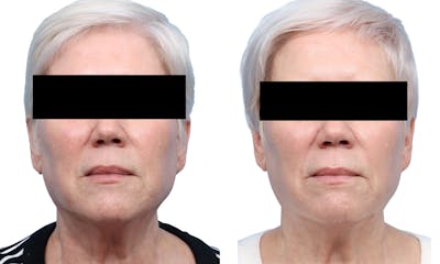 Lutronic Ultra Before & After Gallery - Patient 367952 - Image 1