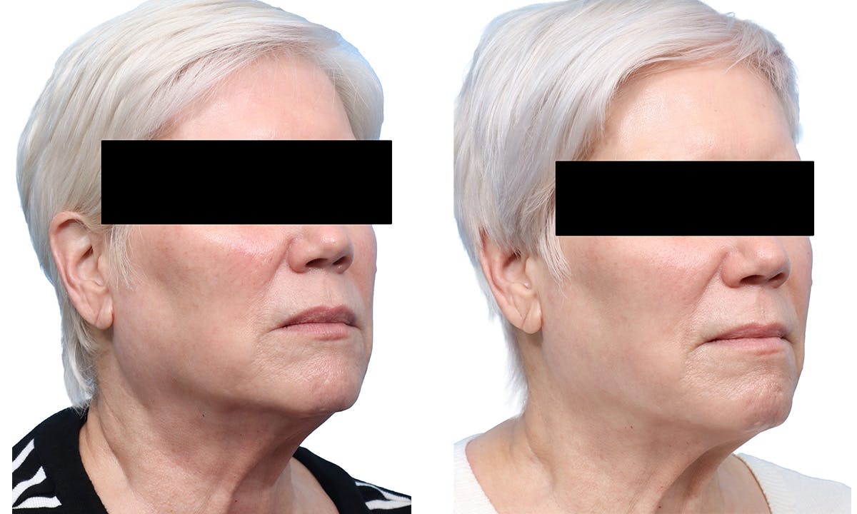 Lutronic Ultra Before & After Gallery - Patient 367952 - Image 2