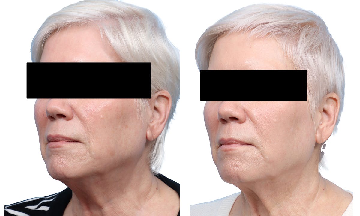 Lutronic Ultra Before & After Gallery - Patient 367952 - Image 3