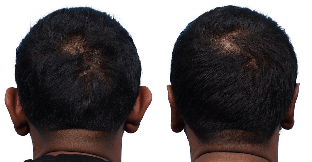 Otoplasty (Ear Surgery) Before & After Gallery - Patient 183629 - Image 1