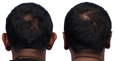 Otoplasty (Ear Surgery) Before & After Gallery - Patient 183629 - Image 1