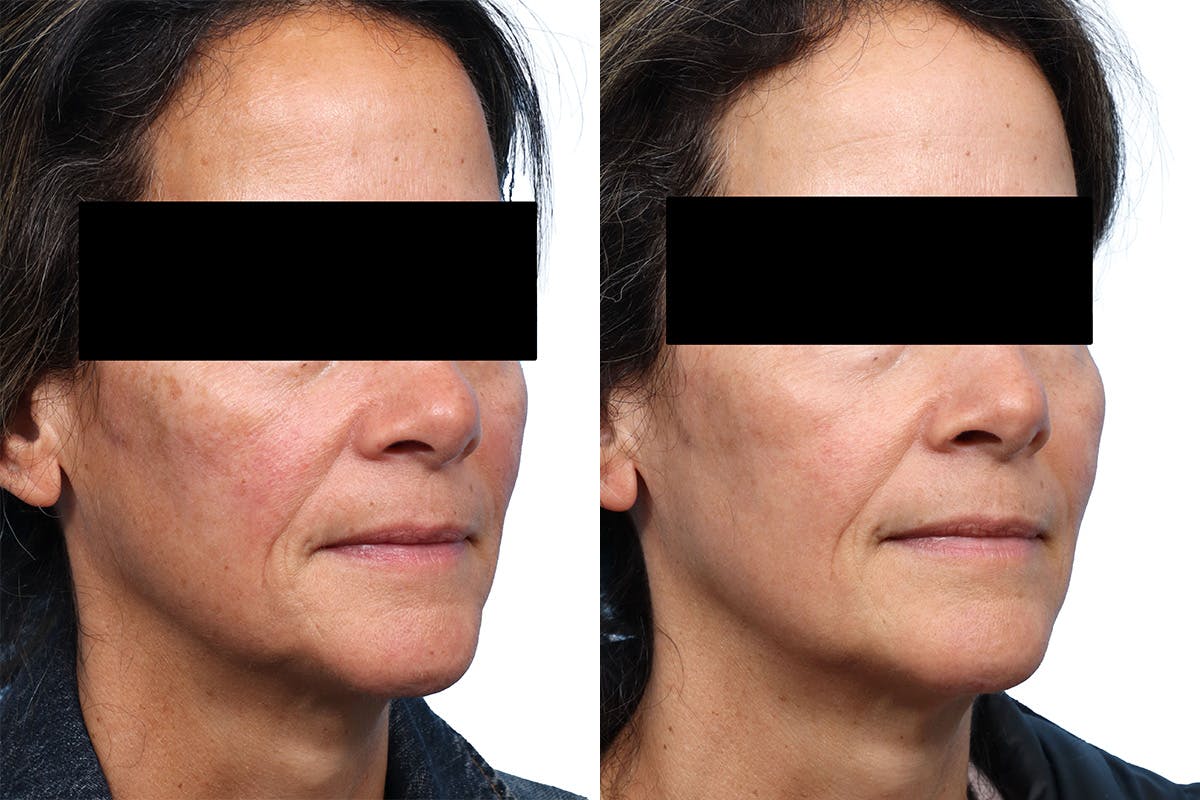CO2 Laser Before & After Gallery - Patient 394556 - Image 1