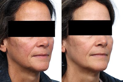CO2 Laser Before & After Gallery - Patient 394556 - Image 1