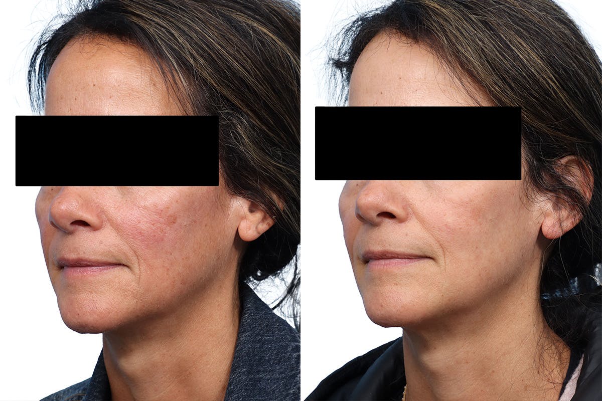 CO2 Laser Before & After Gallery - Patient 394556 - Image 2