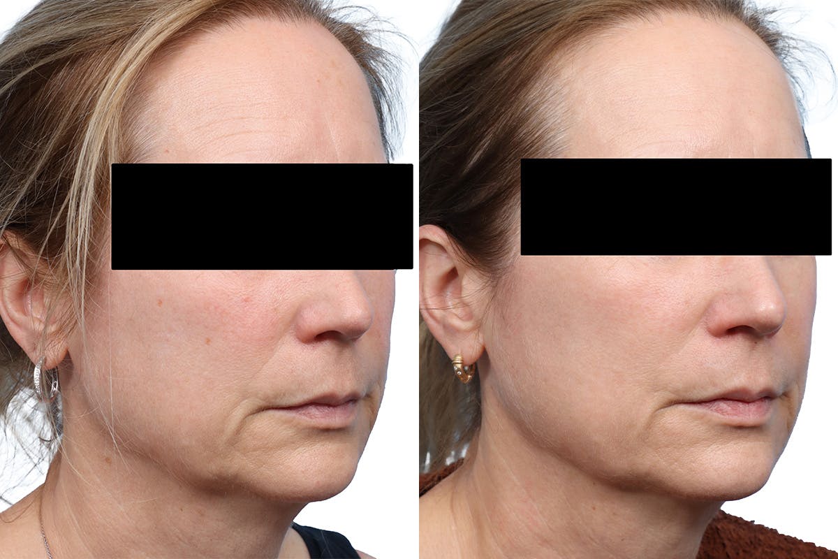 Lutronic Ultra Before & After Gallery - Patient 421800 - Image 1
