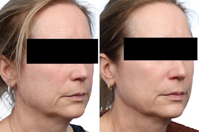 Lutronic Ultra Before & After Gallery - Patient 421800 - Image 1