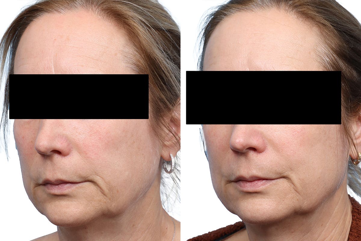 Lutronic Ultra Before & After Gallery - Patient 421800 - Image 2