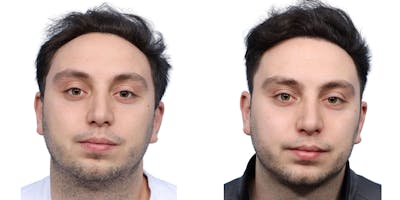 FUE Hair Transplant Before & After Gallery - Patient 108450 - Image 1