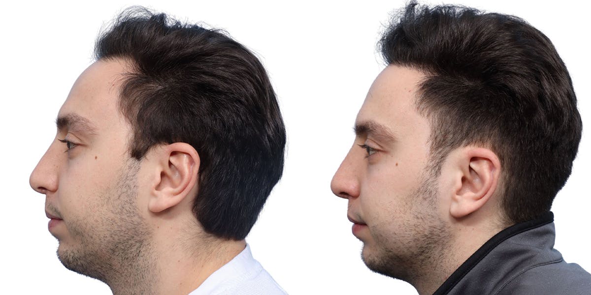FUE Hair Transplant Before & After Gallery - Patient 108450 - Image 3
