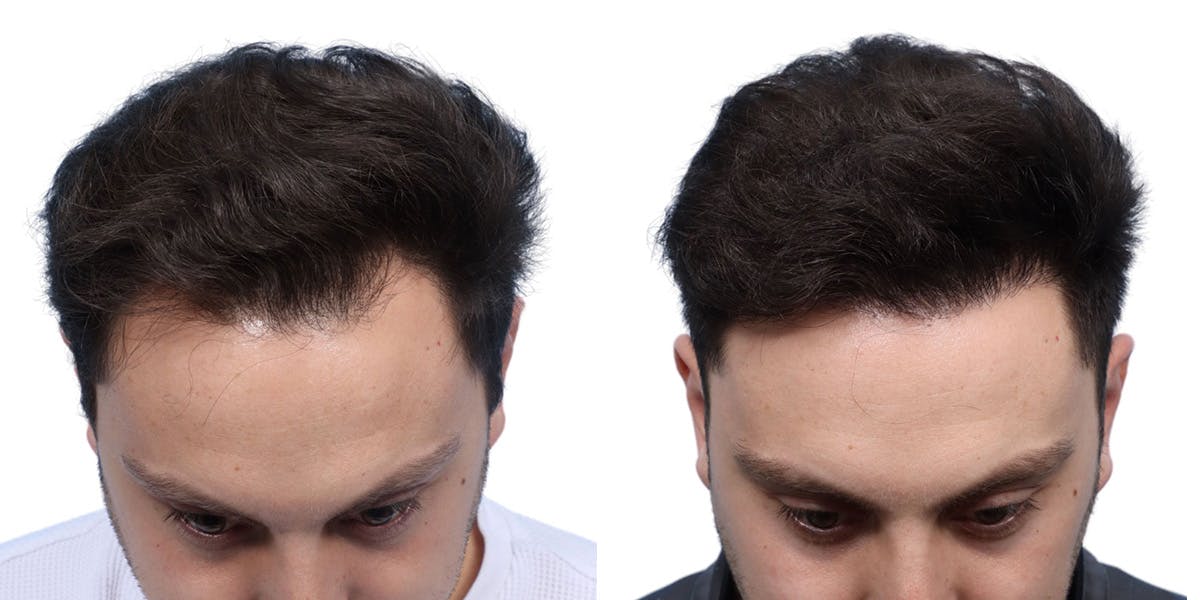 FUE Hair Transplant Before & After Gallery - Patient 108450 - Image 2