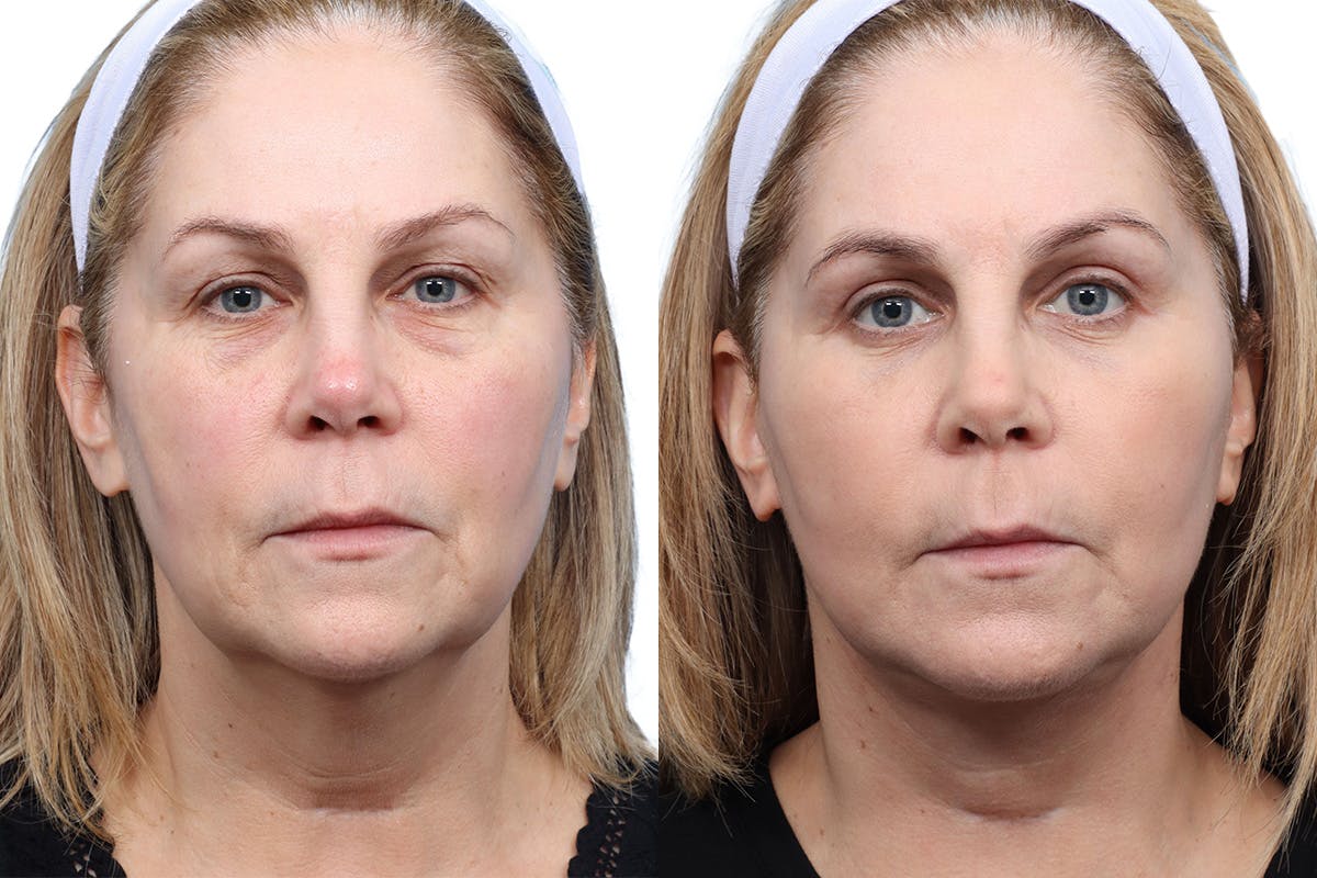 Blepharoplasty (Eyelid Surgery) Before & After Gallery - Patient 294745 - Image 1