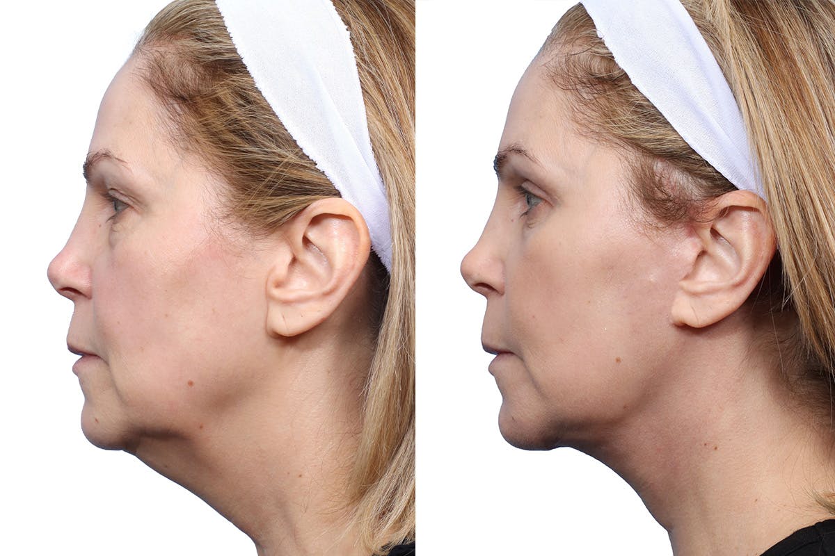 Blepharoplasty (Eyelid Surgery) Before & After Gallery - Patient 294745 - Image 3