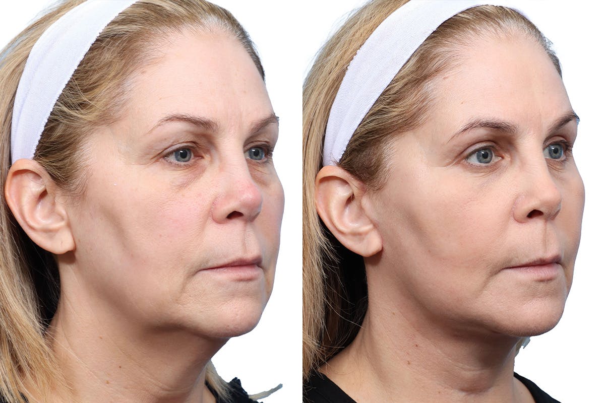 Blepharoplasty (Eyelid Surgery) Before & After Gallery - Patient 294745 - Image 2
