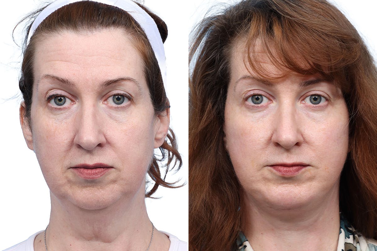 Deep Plane Facelift Before & After Gallery - Patient 611237 - Image 1