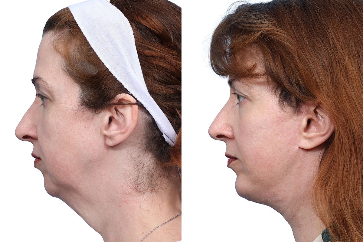 Deep Plane Facelift Before & After Gallery - Patient 611237 - Image 2