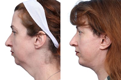 Chin Augmentation Before & After Gallery - Patient 388109 - Image 1