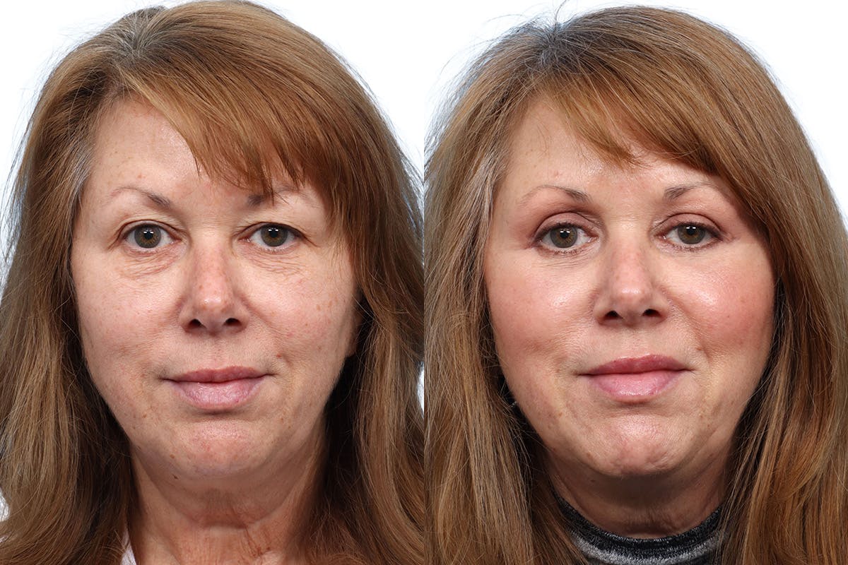 Blepharoplasty (Eyelid Surgery) Before & After Gallery - Patient 174783 - Image 1