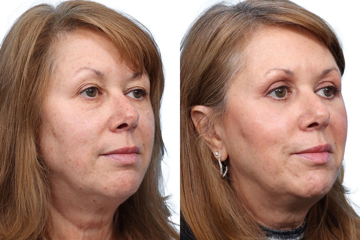 Blepharoplasty (Eyelid Surgery) Before & After Gallery - Patient 174783 - Image 2