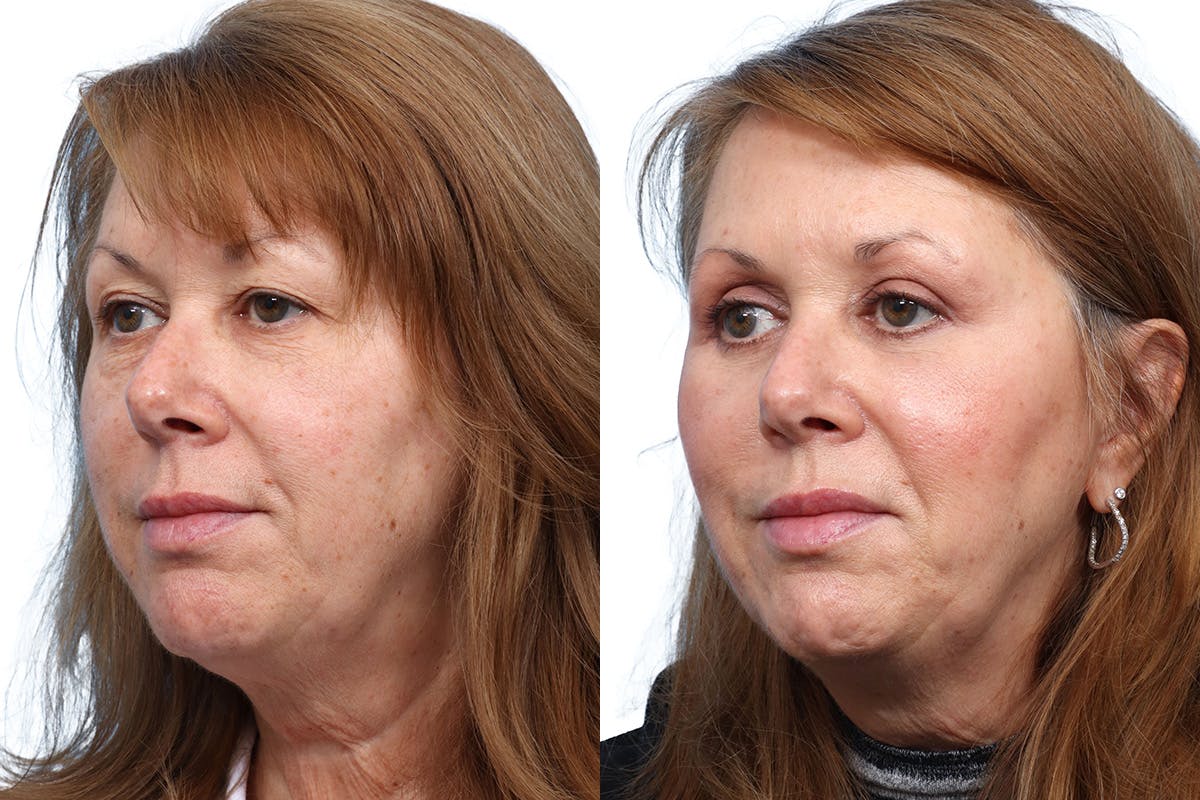 Blepharoplasty (Eyelid Surgery) Before & After Gallery - Patient 174783 - Image 3